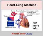 Heart Lung Machine: A machine that takes over the heart's functions when the heart is stopped during open-heart surgery, allowing blood and oxygen to circulate.