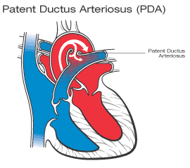 CONGENITAL CARDIOVASCULAR DISEASE