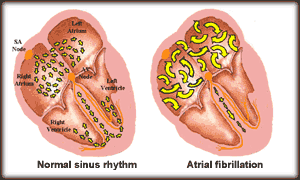 Normal Sinus Rhythm