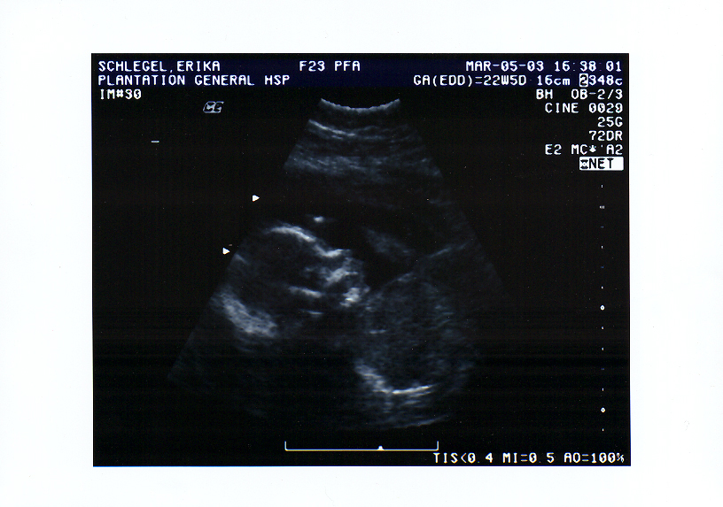ultrasound picture