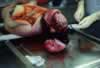 autopsy