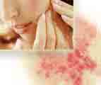 Acne Pimples Treatment Cure Acne Pimples Herbal Herbs Medicine Treatment Cure KL Kuala Lumpur