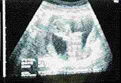 Ultrascan A