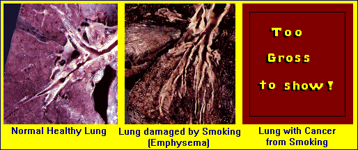 lungs with disaeses