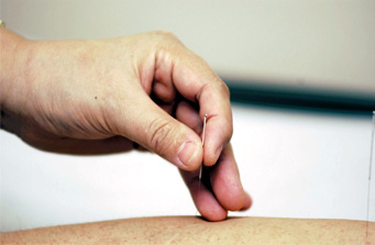 Acupuncture
