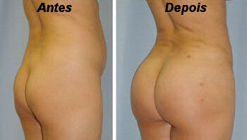 PLastica bumbum