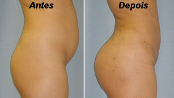 Aumento do Bumbum