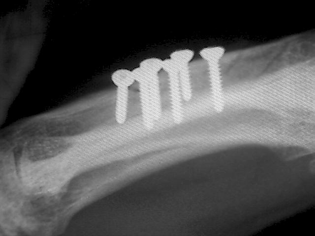 X-Ray showing 6 screws in place
