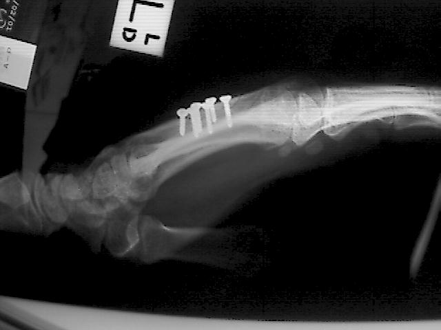 X-Ray showing 6 screws in place