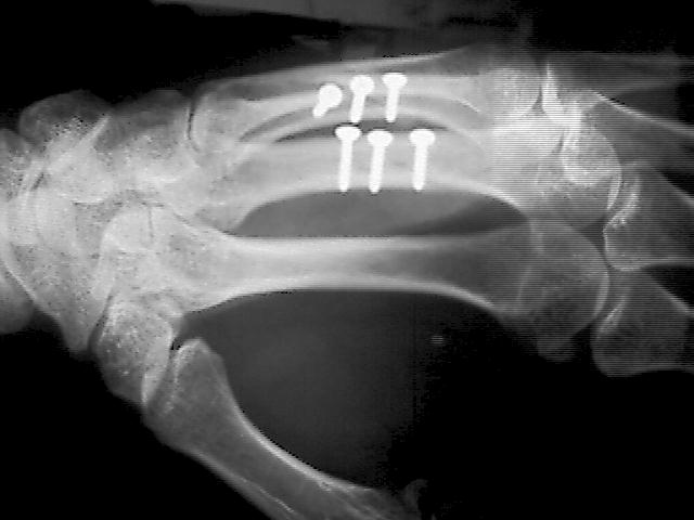 X-Ray showing 6 screws in place