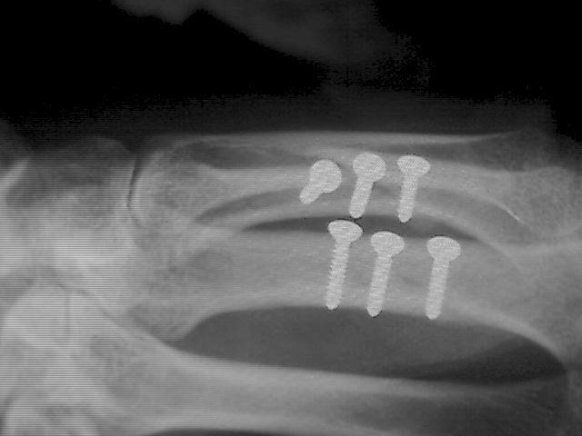 X-Ray showing 6 screws in place