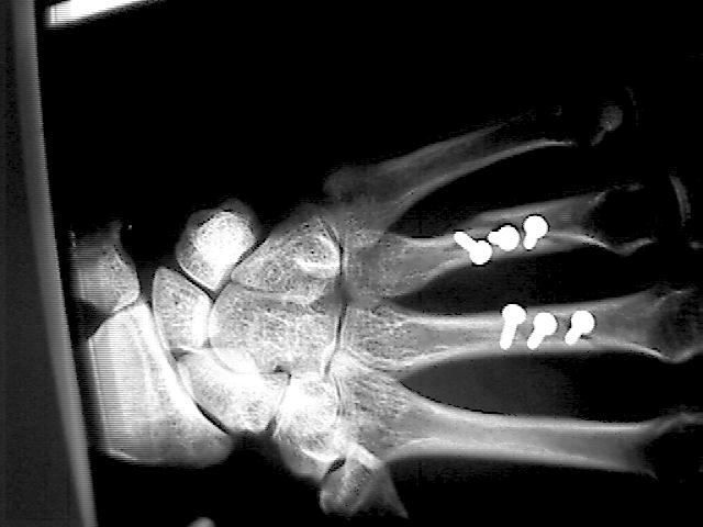 X-Ray showing 6 screws in place