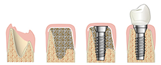 picture of implant process