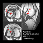 knee - MPR of ACL tear