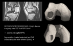 knee - Konig's disease