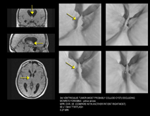 brain - virtual endoscopy