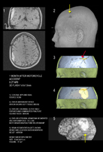 skull comminuted fracture and epidural hematoma