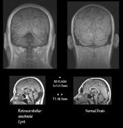 retrocerebellar cyst