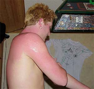 Jeremy sunburn