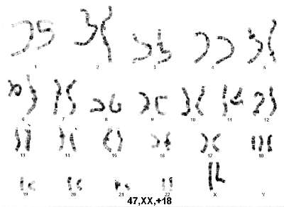 Karyotype of Edward's Syndrome