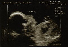 Ultrasound picture of Abigail's profile