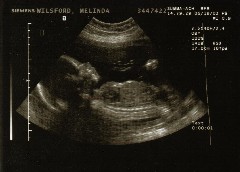 Ultrasound picture of Abigail's profile