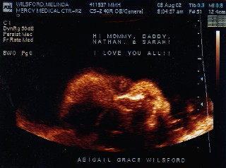 Ultrasound picture of Abigail's face