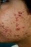 Women Herbs Acne Treatment