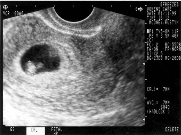1st Sonogram