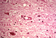 Human brain with holes