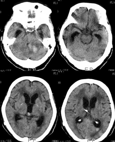 hydrocephalus1.jpg (67328 bytes)
