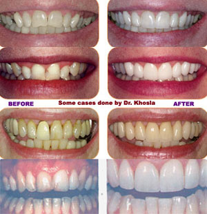 Before & after pics of veneers