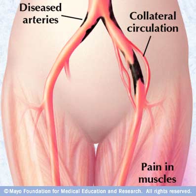 Image showing intermittent claudication