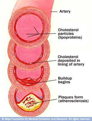 Illustration showing development of atherosclerosis